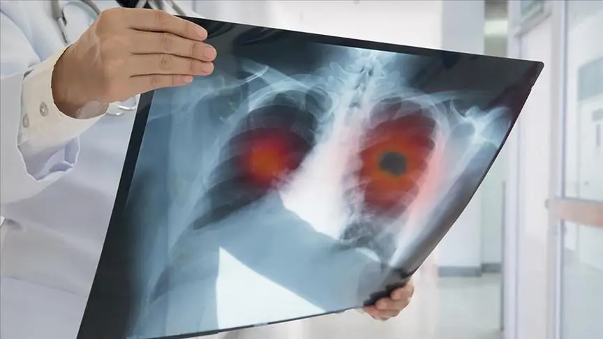 Türkiye'de yılda ortalama 41 bin kişi akciğer kanserine yakalanıyor. 