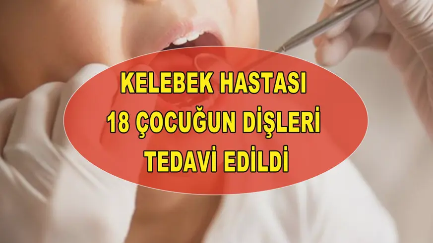 Kelebek hastası 18 çocuğun dişleri tedavi edildi