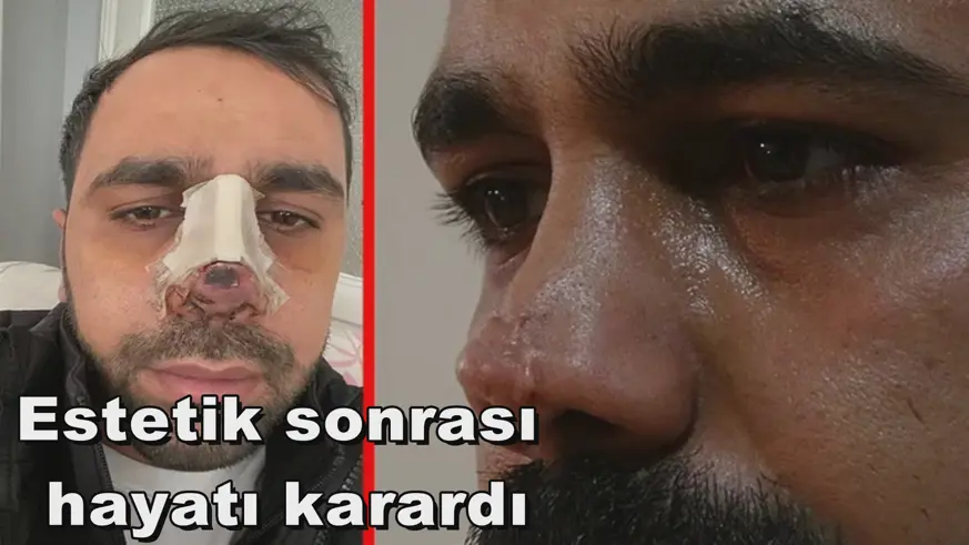 Estetik sonrası  hayatı karardı
